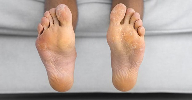 هایپرهیدروز یکی از عوامل ژنتیکی عرق پا است.